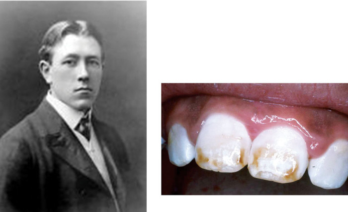 Dentist - Brown Teeth